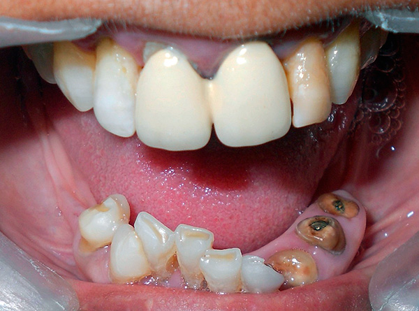 Die Indikation zur basalen Implantation ist das Fehlen von Zähnen in einer Menge von mehr als 3.