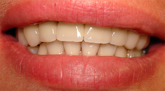 Bei richtiger Mundpflege kann Metallkeramik Ihnen mehr als 10 Jahre und möglicherweise ein ganzes Leben lang dienen.