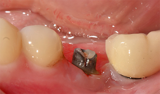 Die Entzündung im Bereich des Implantats wird Periimplantitis genannt.