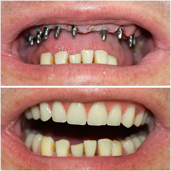 La implantación basal tiene muchas ventajas, por ejemplo, le permite devolver rápidamente una hermosa sonrisa a una persona.