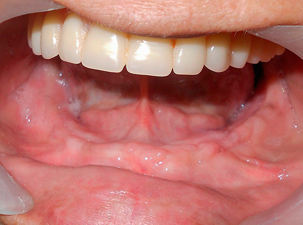 Un ejemplo de la restauración de la dentición en la mandíbula inferior mediante implantes basales.