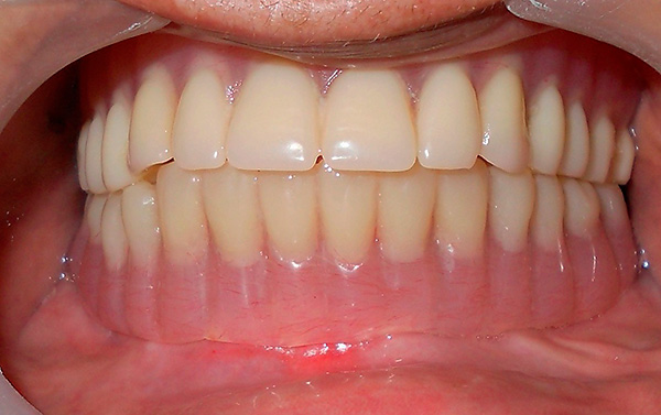 Một hàm răng giả được lắp đặt trên implant - kết quả là, tính thẩm mỹ và chức năng của răng được phục hồi.