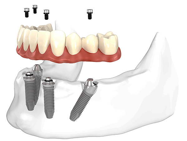 사진은 All-on-4 방법 (4 개의 임플란트)을 사용하여 치아의 보철을 개략적으로 보여줍니다.