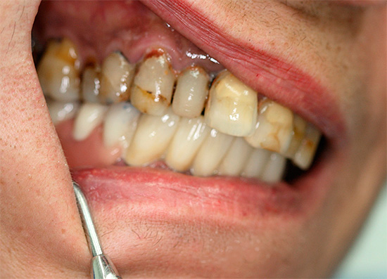 Преди процедурата, състоянието на устната кухина и челюстта на пациента е внимателно изследвано.