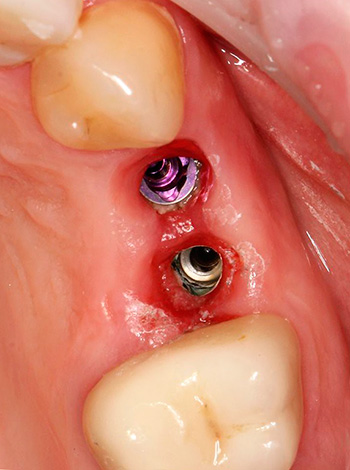 La péri-implantite est une inflammation dans le domaine des implants dentaires établis.