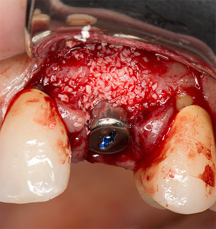 La foto muestra un ejemplo de instalación del implante simultáneamente con injerto óseo.
