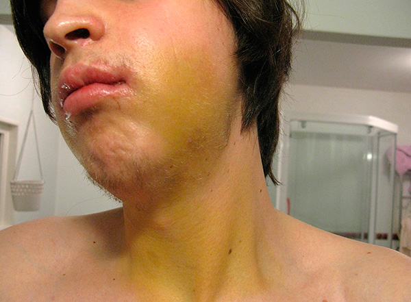 A veces, después de instalar implantes en la cara e incluso en el cuello, se puede observar un hematoma.
