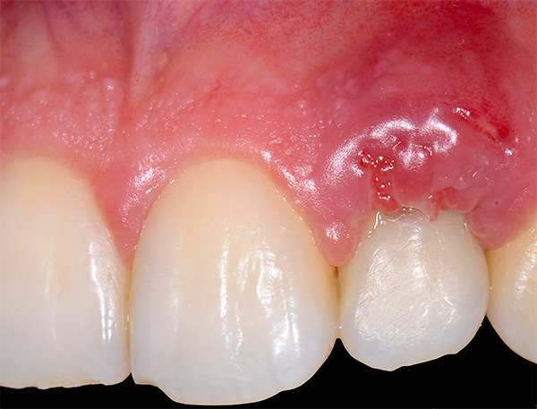 La fotografía muestra una inflamación en el área del implante dental de la mandíbula superior; desafortunadamente, a veces ocurren complicaciones después de la implantación.