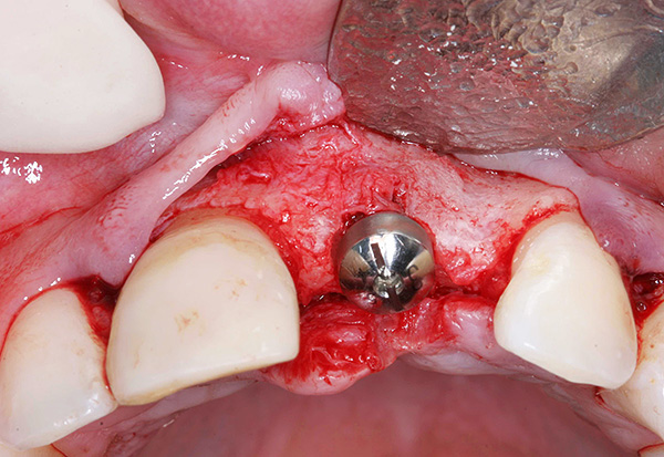 Des problèmes peuvent survenir à la fois pendant et après l’installation apparemment réussie de l’implant.