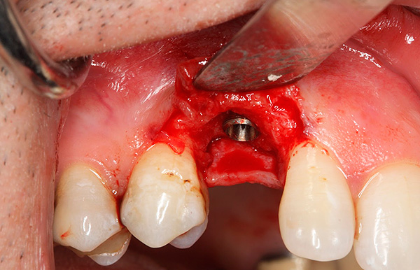 L’opération d’implantation de la dent dans son ensemble est assez traumatisante, il est donc généralement impossible de le faire sans saignement.