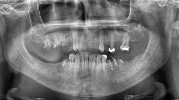 Esta imagen panorámica muestra claramente que la distancia desde los dientes de la mandíbula superior hasta los senos maxilares es muy pequeña.