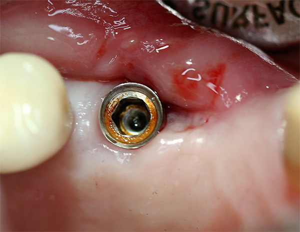 Corrosión de implantes dentales