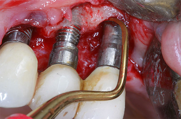 Con una inflamación severa, el médico puede abrir las encías y limpiar la herida del pus.