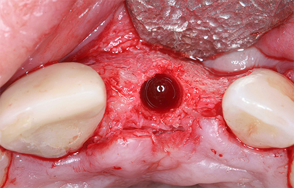 Η φωτογραφία δείχνει ένα παράδειγμα επανεμφύτευσης μετά την αποκατάσταση του οστικού ιστού της κυψελιδικής διαδικασίας.