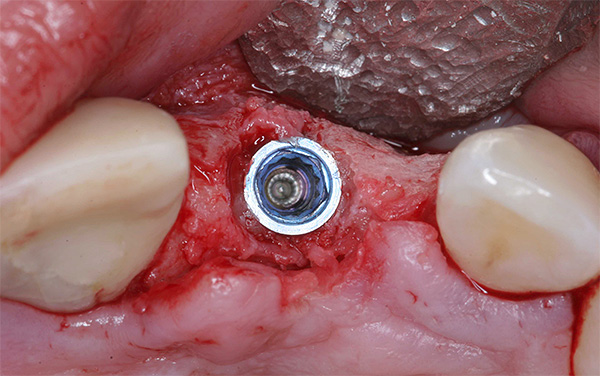 Implante insertado en hueso reconstruido.