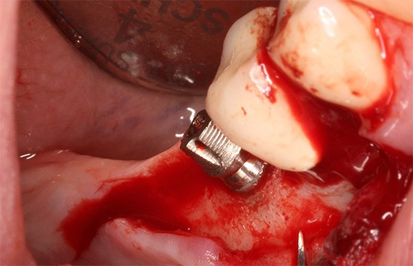 La implantación dental es un procedimiento quirúrgico bastante traumático.