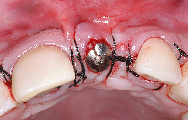 Un bout est placé sur l'implant et la plaie est suturée.