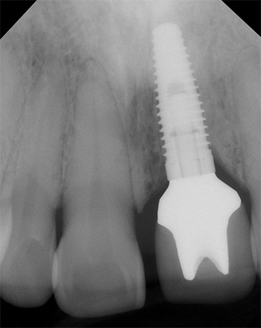 Le processus d'accrétion de l'implant avec l'os de la mâchoire est influencé par de nombreux facteurs, dont certains peuvent parfois compliquer l'ostéointégration.