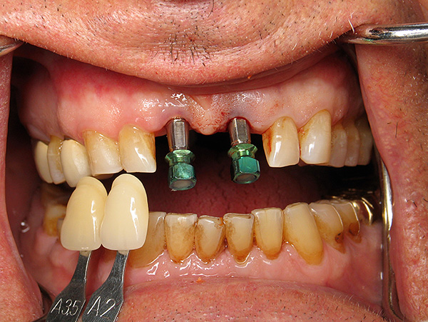 Parodontitis und Parodontitis verursachen eine Reihe von Schwierigkeiten bei der Implantation von Zähnen, aber nicht alles ist so hoffnungslos, wie es auf den ersten Blick scheinen mag ...