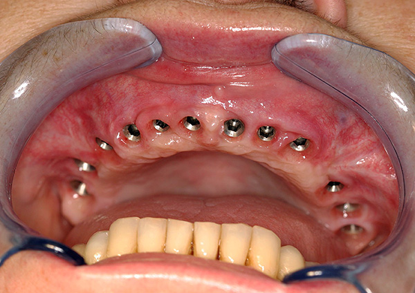 Nach der Entfernung aller Zähne kann die Implantation durchgeführt werden.