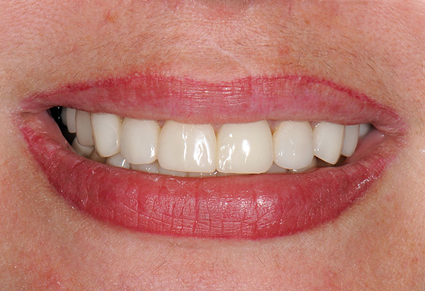 El resultado del reemplazo de todos los pacientes y la pérdida de dientes con implantes es una sonrisa hermosa y uniforme y la capacidad de masticar normalmente.