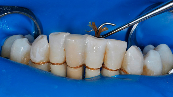 사진은 특별한 실을 가진 치아 부목의 예를 보여줍니다.