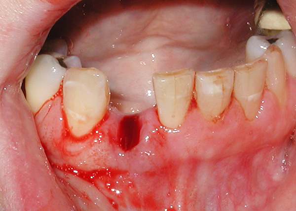 Lorsque la maladie parodontale est très dangereuse, laissez un espace vide dans la dentition sans attention ...