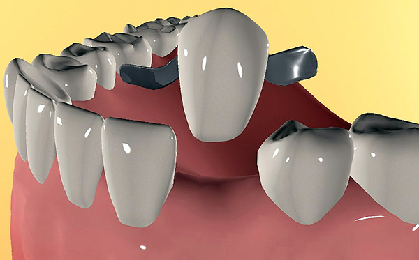 Même après le traitement d'une parodontite, les dents risquent de devenir mobiles et de ne plus pouvoir tenir le pont.