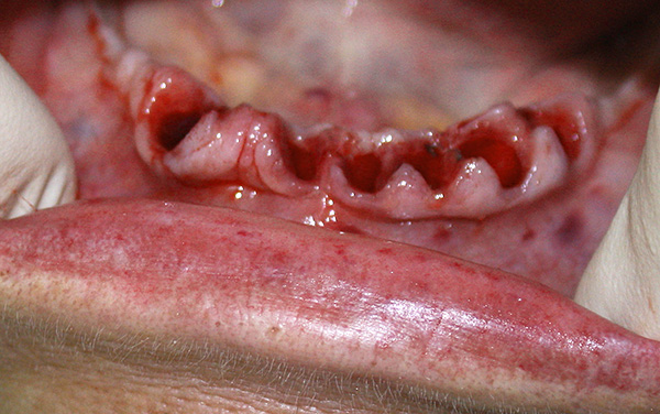 Σε σοβαρές μορφές περιοδοντίτιδας, εκτελείται συχνά πολλαπλή εξαγωγή δοντιών (στη συνέχεια, τα εμφυτεύματα μπορούν να εγκατασταθούν στη θέση τους).