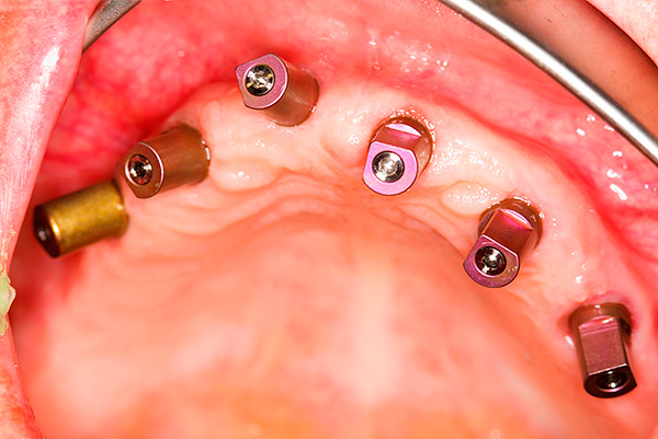 Häufig mit Parodontitis wird die vollständige Entfernung der Zähne mit gleichzeitiger Implantatinsertion durchgeführt.