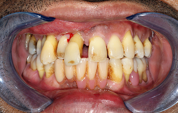 Dişlerin durumuna bağlı olarak, bireysel bir tedavi planı farklı olabilir ...