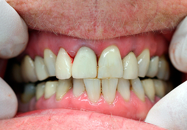 La photo montre un exemple de parodontite.