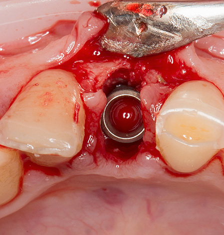 Con la periodontitis y la enfermedad periodontal, se puede realizar una implantación de una etapa inmediatamente después de extraer el diente.