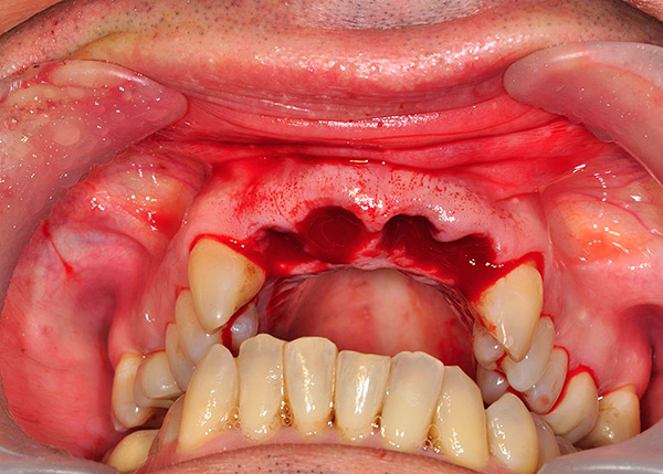 Ví dụ, cấy ghép cơ bản có thể được cài đặt ngay sau khi loại bỏ răng.