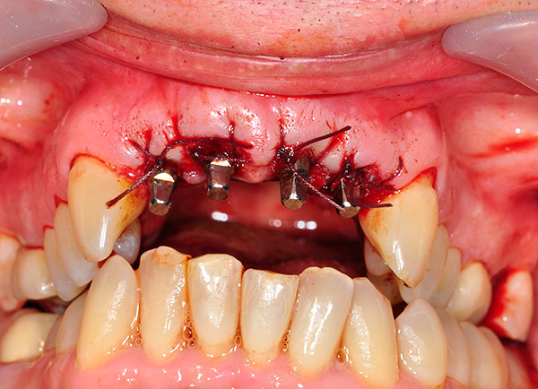 La foto muestra un ejemplo de implantes basales instalados en la mandíbula superior.