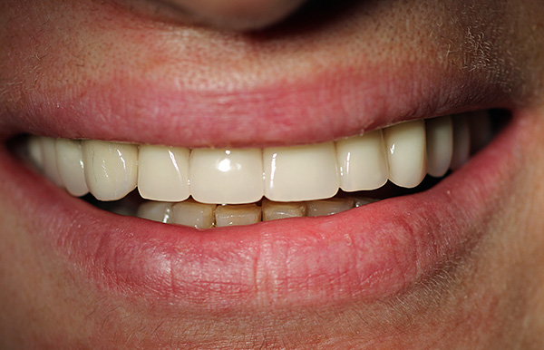 Un soin approprié des implants vous permet de prolonger leur durée de vie, ce qui est particulièrement important dans les cas de parodontite persistante (maladie parodontale).
