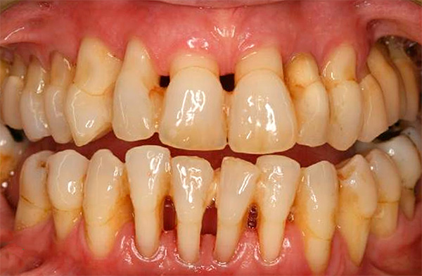 Y aquí - la enfermedad periodontal.