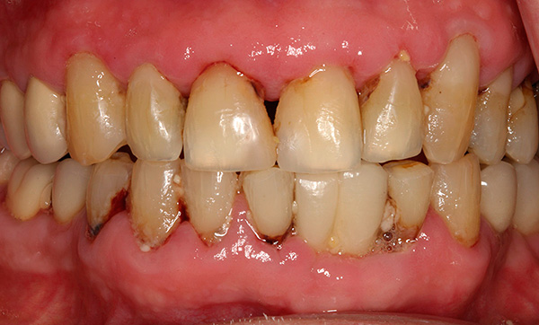 La periodontitis no solo se acompaña de síntomas muy desagradables, sino que también conduce a una pérdida activa del tejido óseo de la mandíbula.