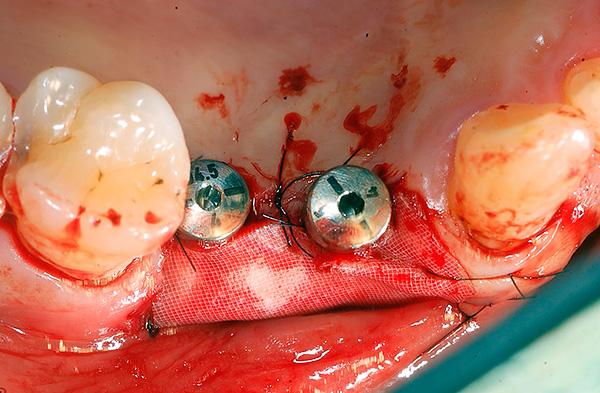 Mit der Zeit kann die Implantation den Verlust von Knochen wirklich stoppen, indem die Infektionsquelle entfernt und eine Kaubelastung für den Knochen erzeugt wird.