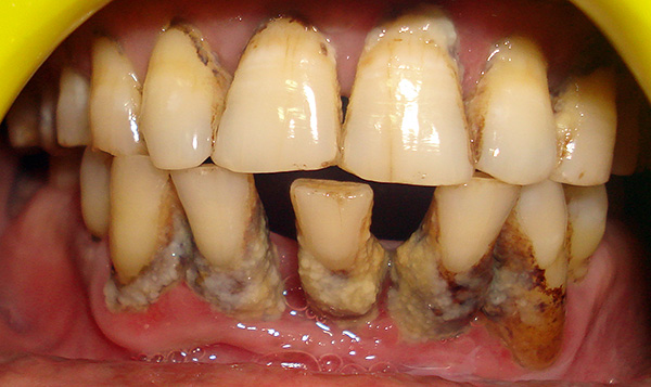 심각한 형태의 치주염에서는 모든 치아를 제거해야합니다.