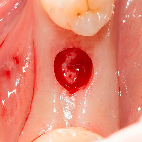 L'incision de gomme montrée sur la photo a été réalisée à l'aide d'un mucotome circulaire.