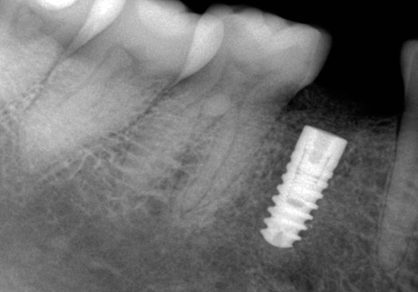 No olvide que incluso con implantes no quirúrgicos, a pesar del daño mínimo en las encías, tendrá que perforar la mandíbula para instalar un implante.