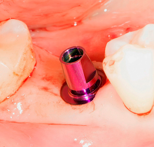 Bien que la publicité parle d’une méthode non invasive d’implantation d’implants, l’opération a bien lieu.
