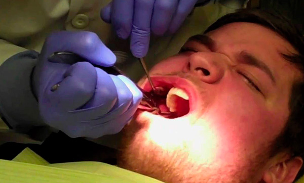 Si la extracción del diente no se realiza completamente sin problemas, el médico puede decidir abandonar la instalación simultánea del implante.