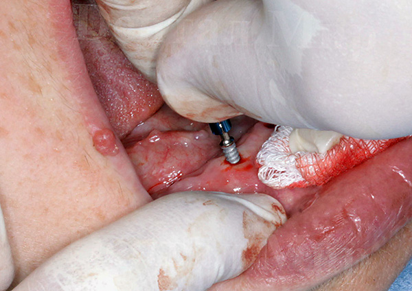 La foto muestra un ejemplo de instalación de un implante en la mandíbula.