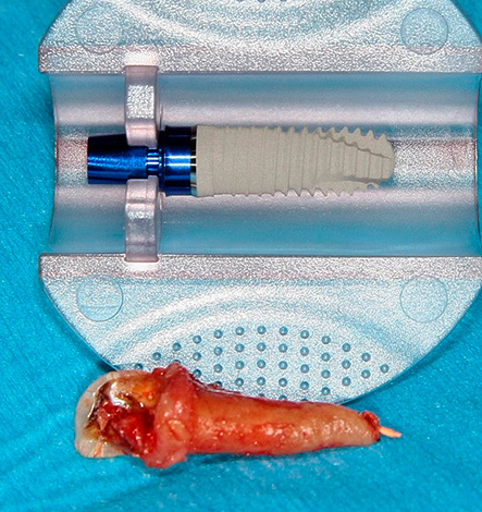 Avec l'implantation rapide, l'implant dentaire est installé dans le puits immédiatement après la procédure d'extraction dentaire.