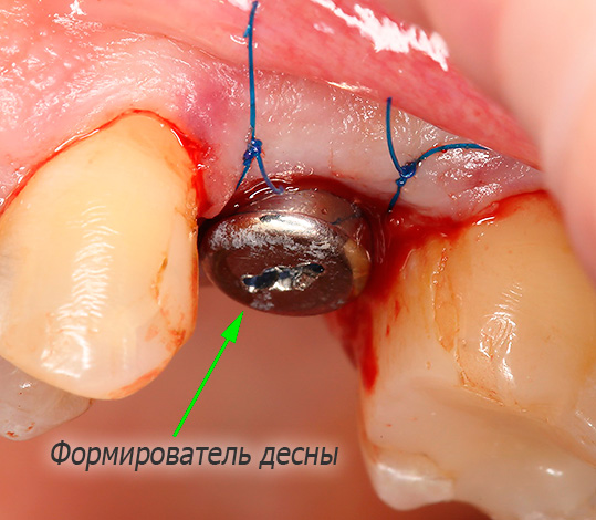 El formador de goma se coloca inmediatamente en el implante recién instalado.