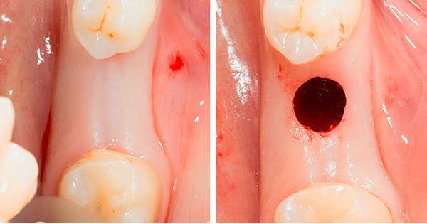 Con el llamado implante no invasivo de dientes, se realiza una incisión de las encías de todos modos: es simplemente circular, no longitudinal.