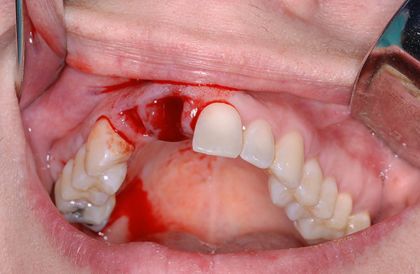 El agujero fresco después de la extracción del diente suele ser bastante adecuado para insertar un implante en él.