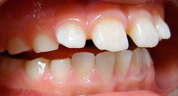 Με ανοιχτό δάγκωμα, σχηματίζεται μια σαγιονιασμένη σχισμή ανάμεσα στα δόντια.